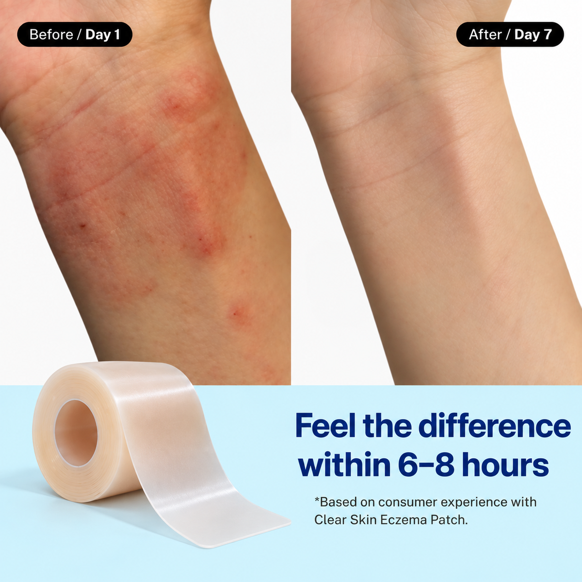 Eczema Flare Patch (16 feet roll)