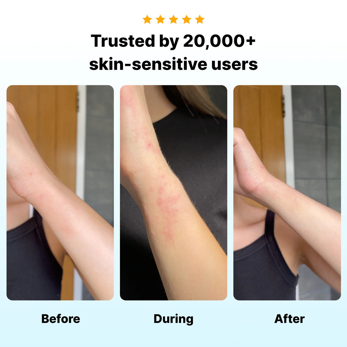 Eczema Flare Patch (16 feet roll)